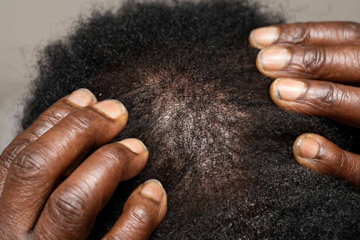 Scalp Treatment Secrets: Why Your Hair Cap Might Be the Missing Link